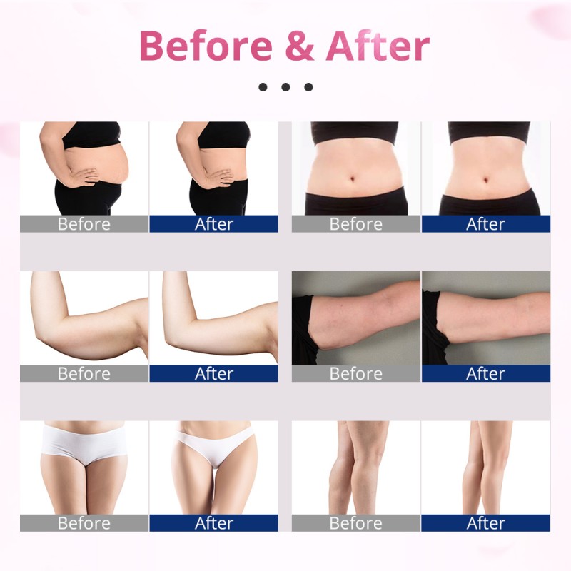 lipolaser body contouring treatments