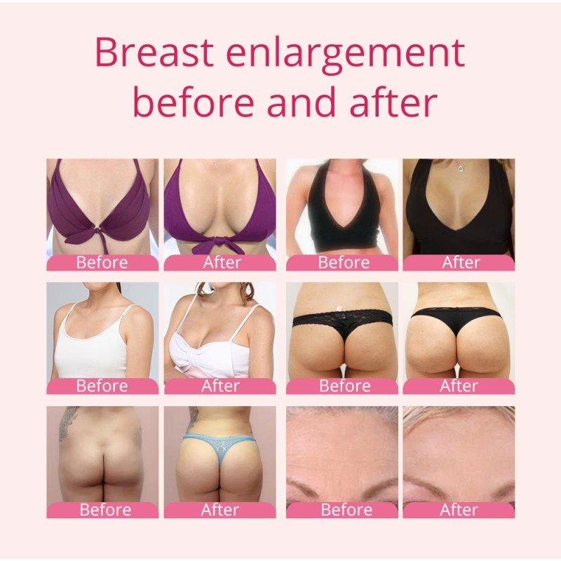 vacuum therapy breast lift