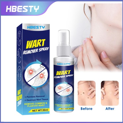 Wart Remover Spray 30ml Painless Effective Unisex Body Mole Skin Tag Remover