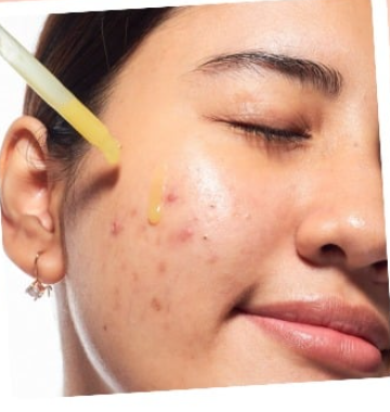 Does Salicylic Acid Help With Acne Scars?