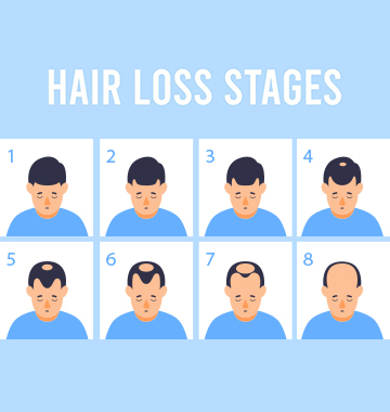 When Does Male Pattern Baldness Start And How To Prevent It