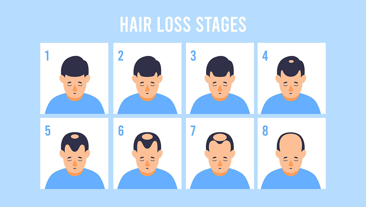 Image pour la requête How do I can stop hairfall?