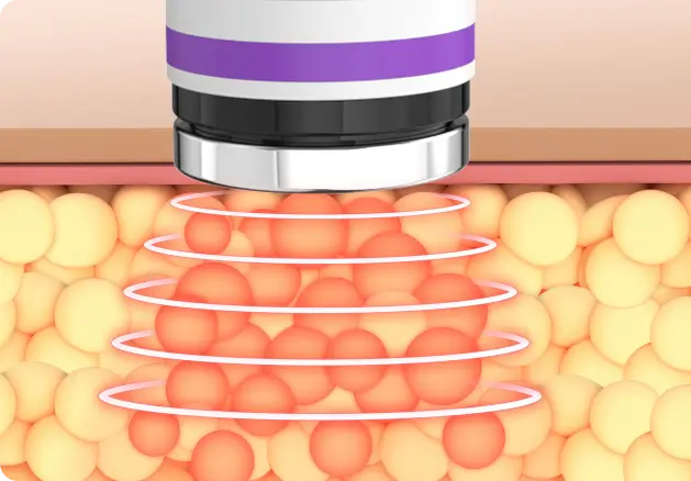 Working principle of cavitation machine