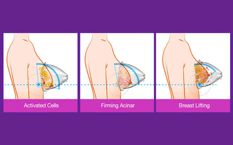 Why vacuum therapy technology is a menu must-have