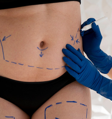 What's The Process Of Cool sculpting | What To Expect
