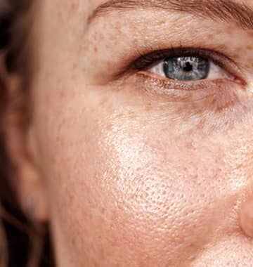 Are freckles sun damage?
