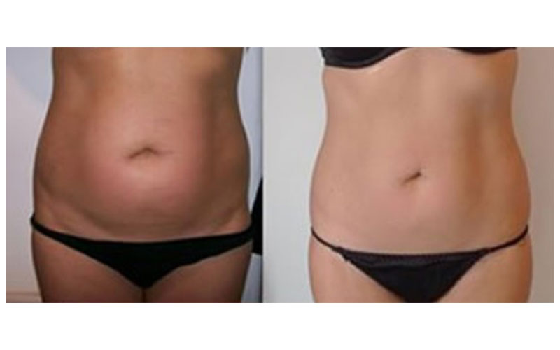 ultrasonic cavitation steps