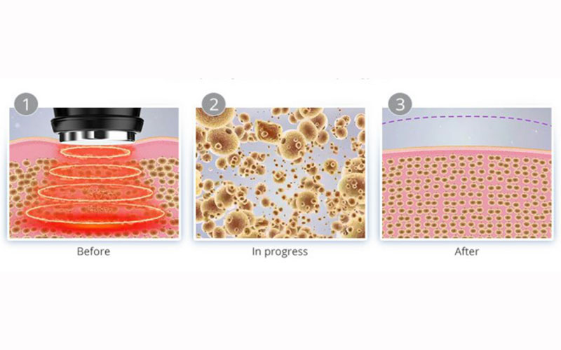 vacuum rf slimming machine
