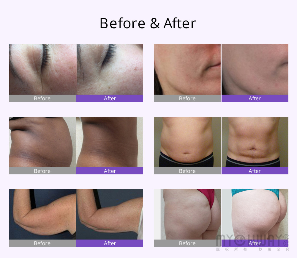 lipo laser cavitation before and after photos